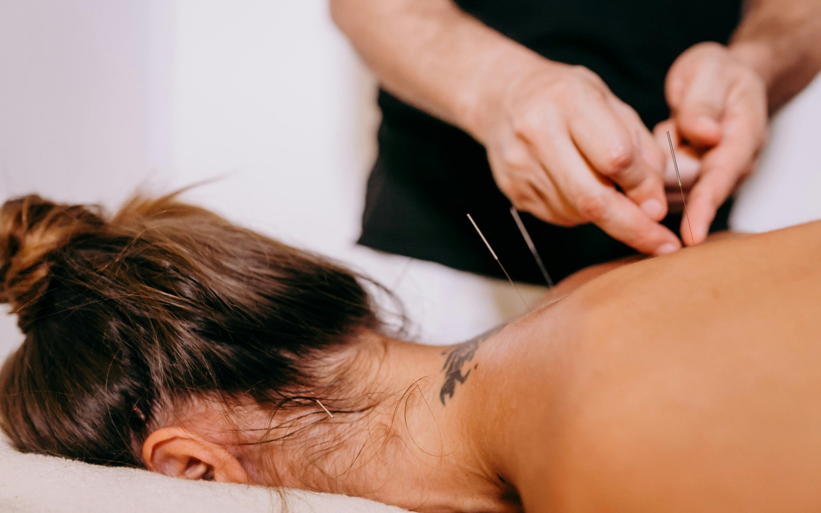Acupuncture treatment for recovery support at Pure Conditioning in Stamford CT